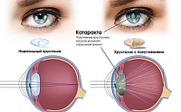 Обезвоживание ведет к катаракте и потере зрения
